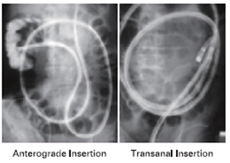 Anterograde Insertion, Transanal Insertion