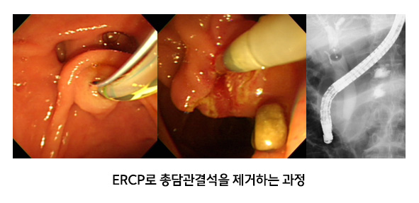 ERCP ѴἮ ϴ 